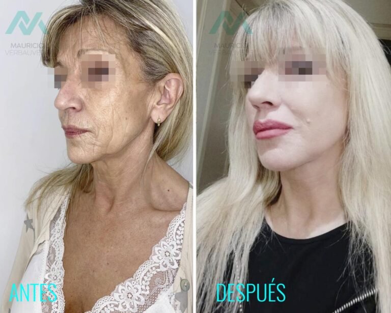 antes-despues-cirugia-lifting facial 2