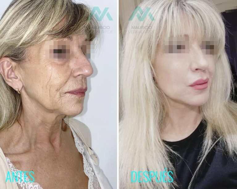 antes-despues-cirugia-lifting facial