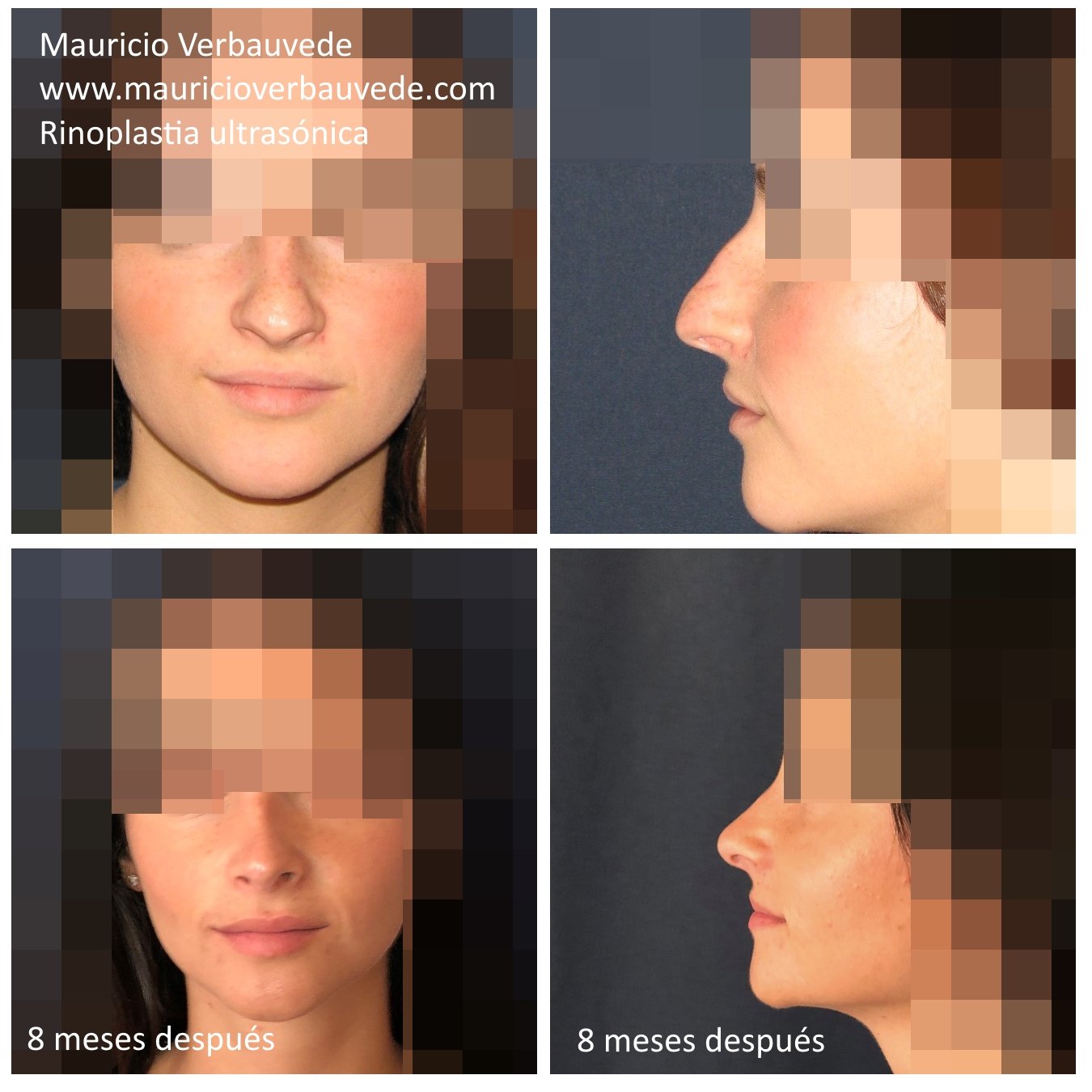 Rinoplastia-ultrasonica-8-meses-despues