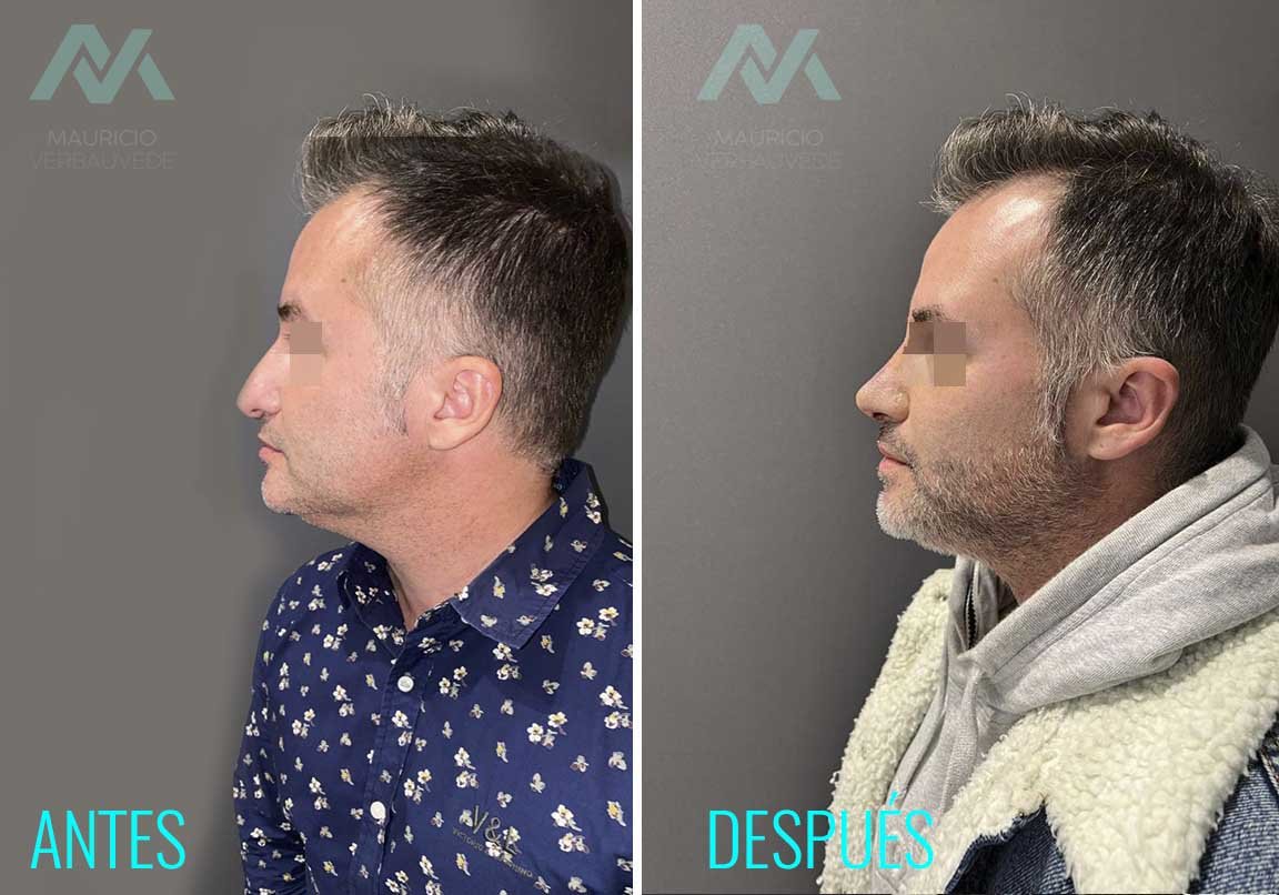 antes-despues-cirugia-correccion-plastica-hombre-nariz-58-2