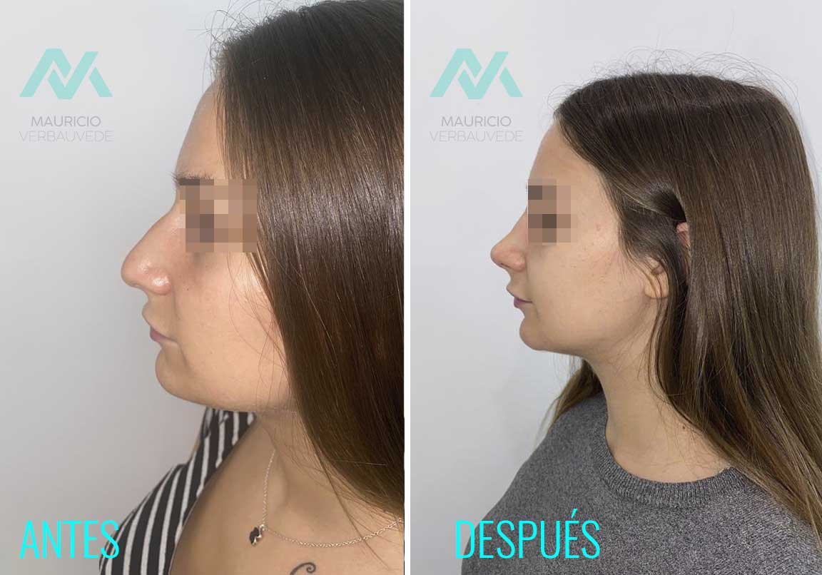 antes-despues-cirugia-nariz-2