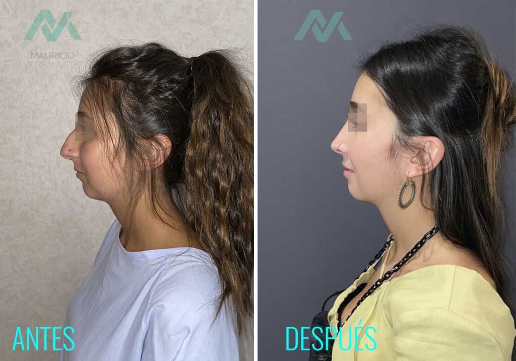 antes-despues-cirugia-perfil-1024x716