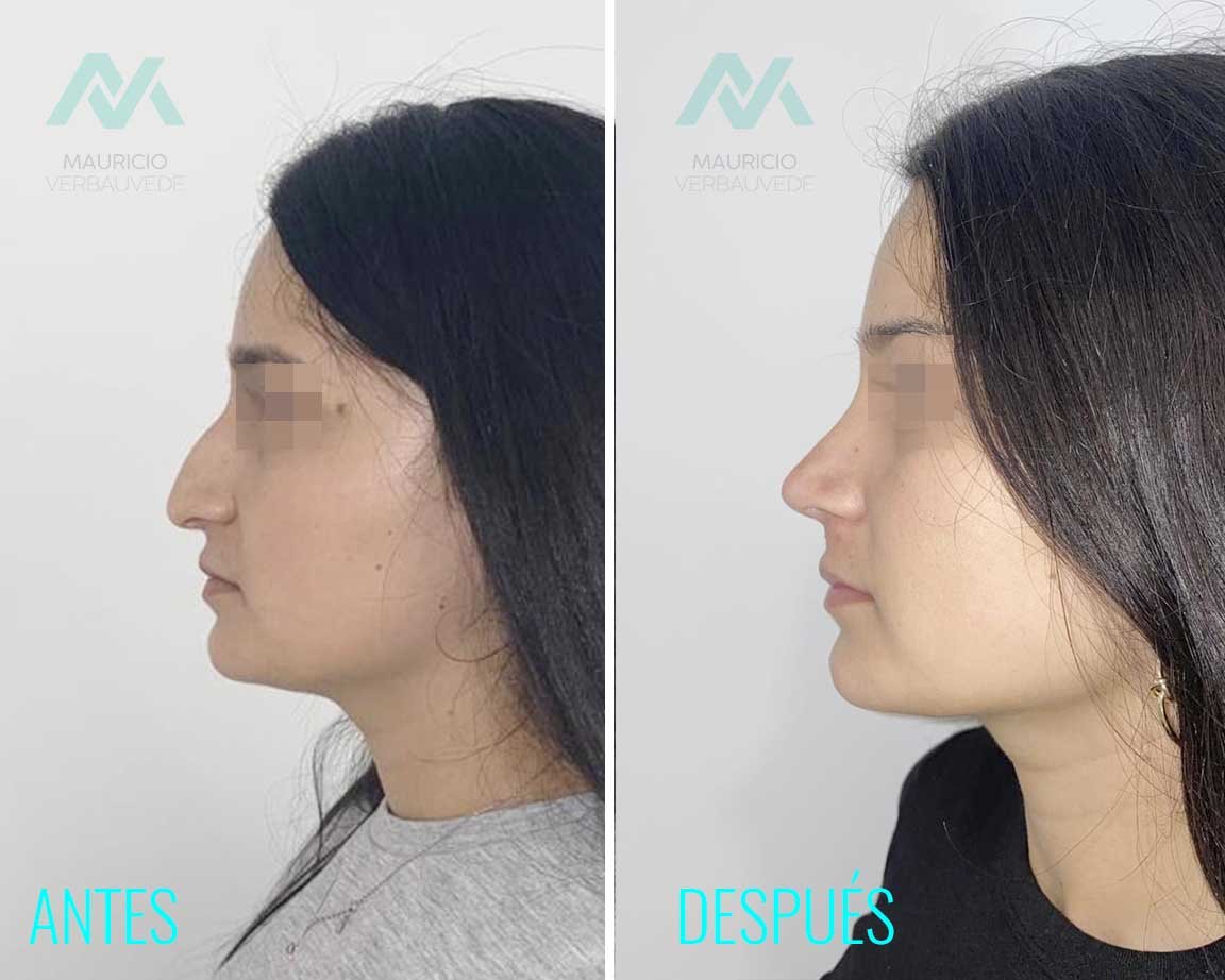 antes-despues-cirugia-rinoplast-copia