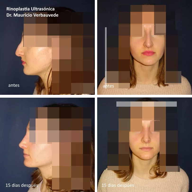 rinoplastia-ultrasonica-15-dias-despues