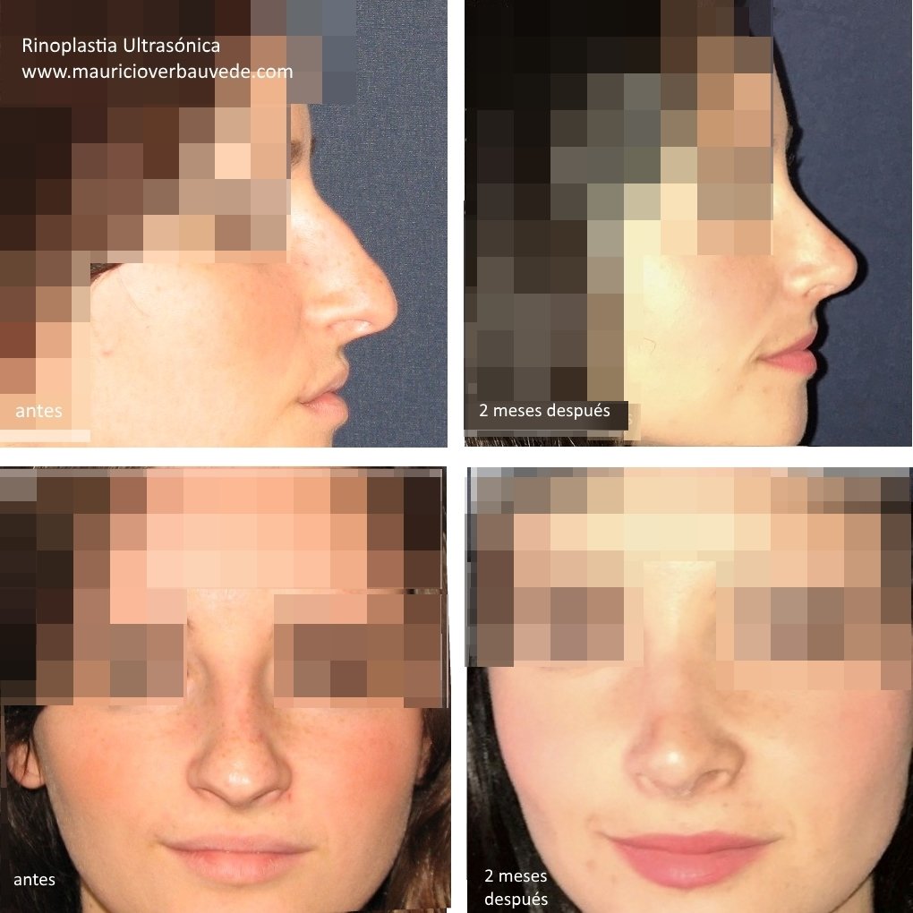 rinoplastia-ultrasonica-antes-2-meses-despues