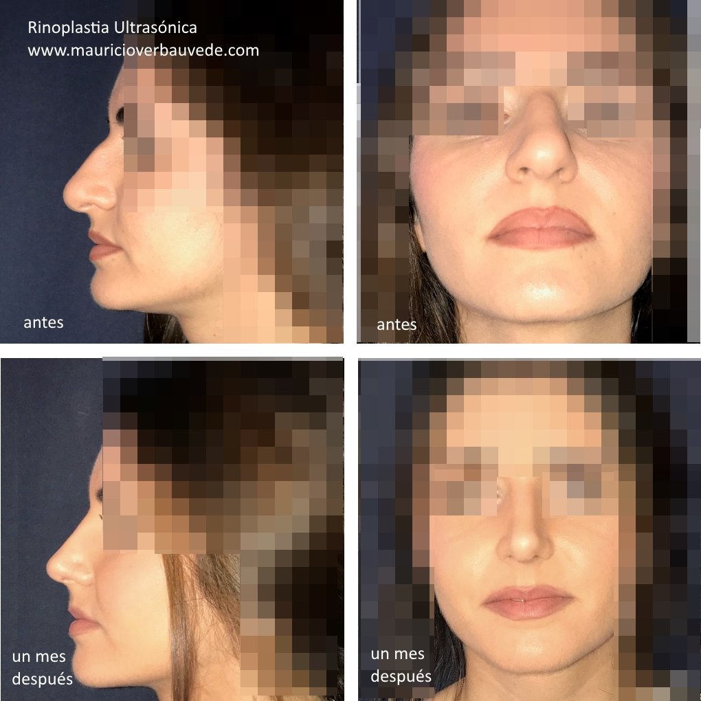rinoplastia-ultrasonica-un-mes-despues