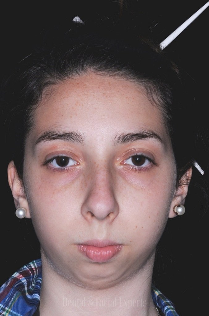 bianca-frente-antes-e-depois-casos-CÇüpia-1