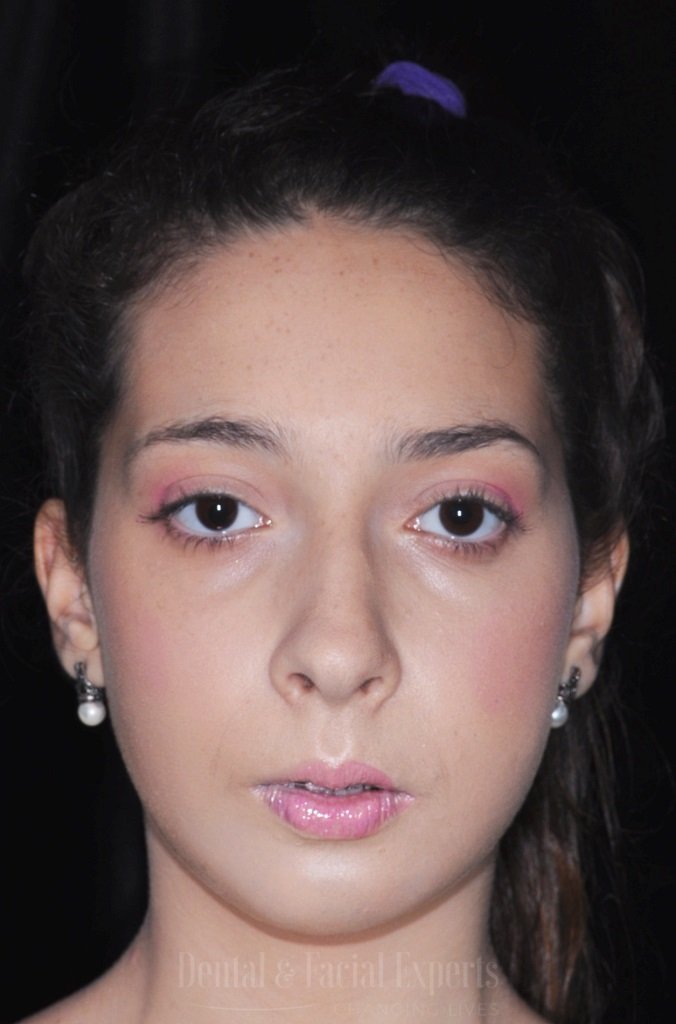 bianca-frente-antes-e-depois-casos