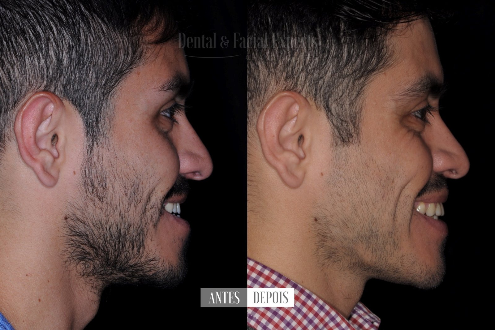 emmanuel-antes-e-depois