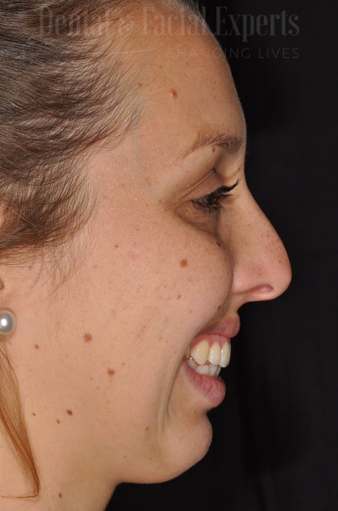 natalia-antes-e-depois-1-CÇüpia-1