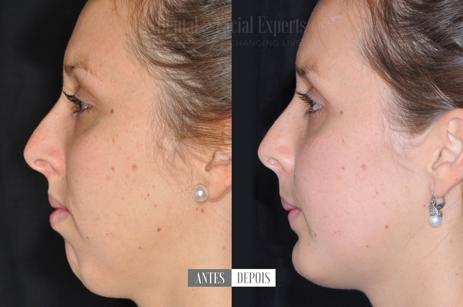 natalia-antes-e-depois-casos