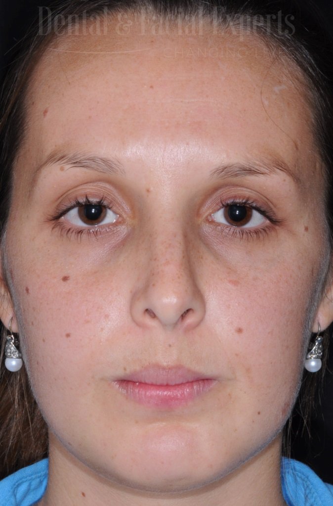 natalia-antes-e-depois-frente-pos