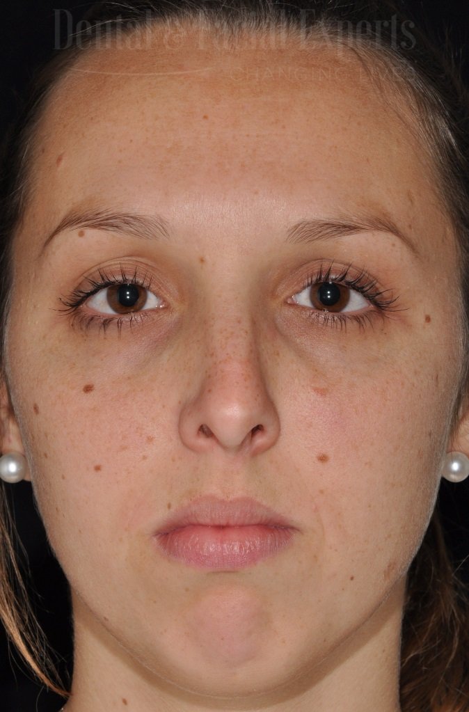 natalia-antes-e-depois-frente-pre