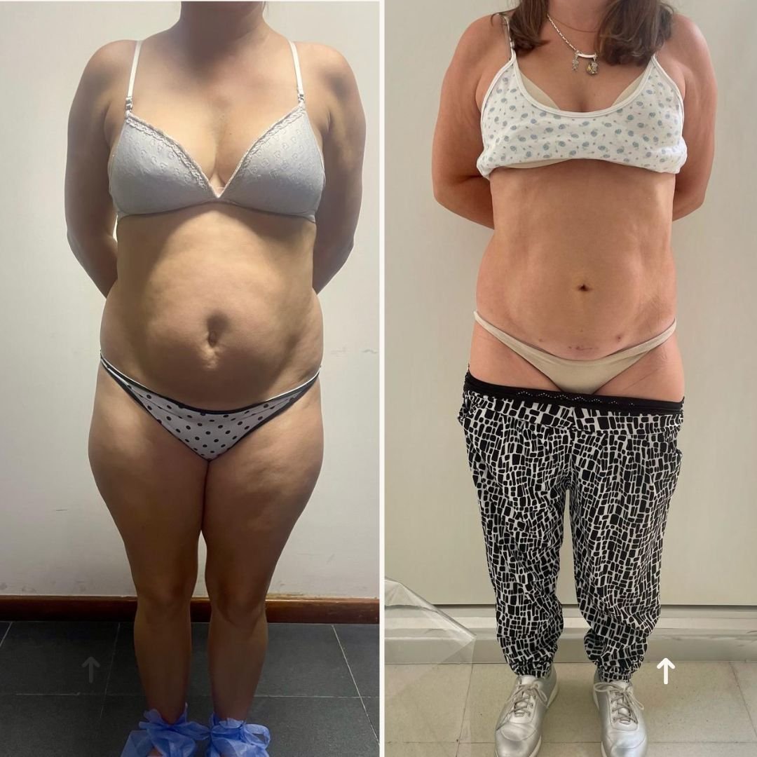 antes y despues dia..8